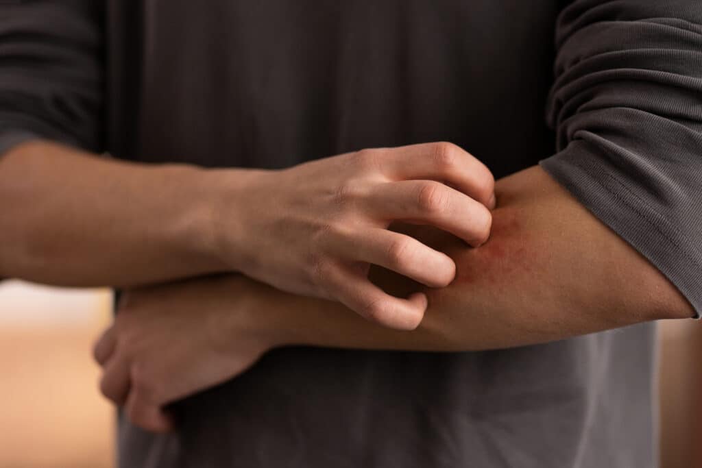 Personne souffrant d'eczema